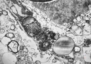 M,71y. | Alzheimer diseaseaccompanied with CADASIL